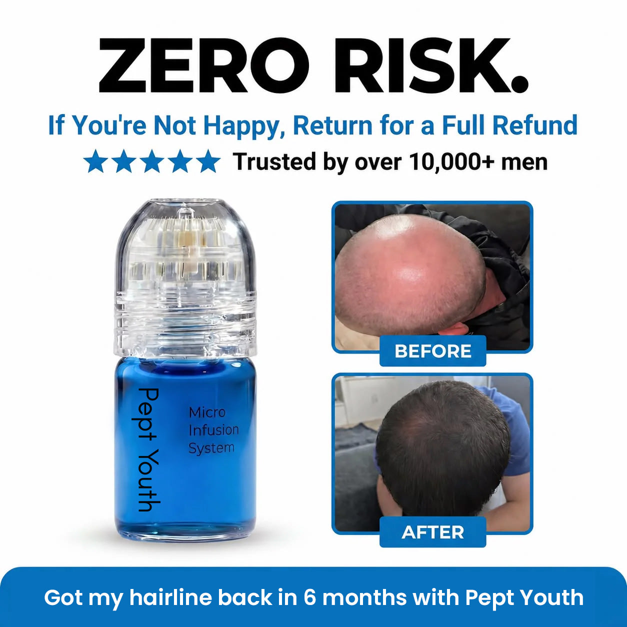 Micro-Infusion Peptide System For Hair Regrowth